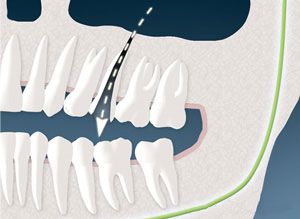 sinus02