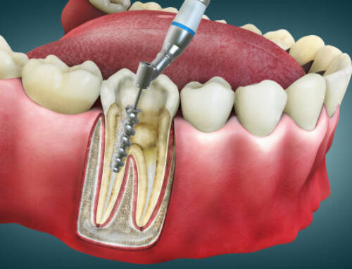 Root Canal Myths vs. Facts: The Real Truth