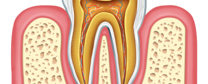 Key Signs You May Need a Root Canal Treatment