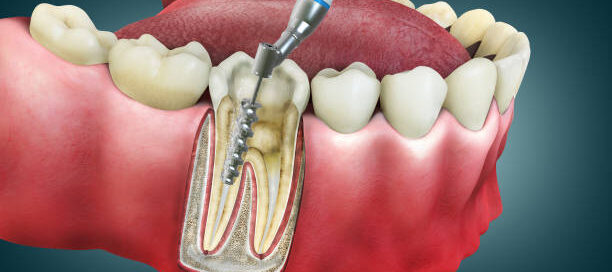 Root Canal Aftercare: Your Recovery Guide